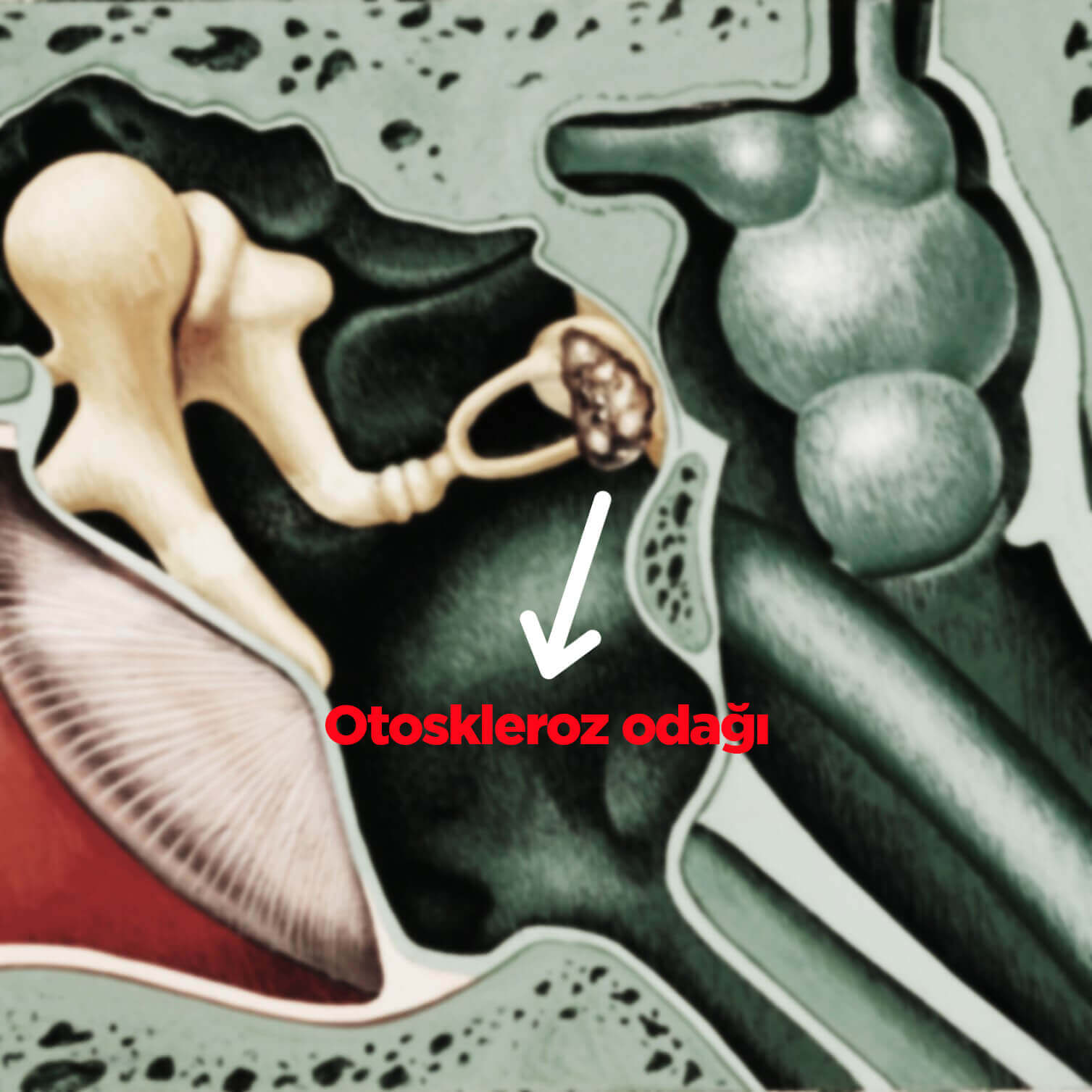 içkulakkireçlenmesi kopya (1) (1)