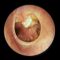 Many patients also have inadequate functioning of the Eustachian tube. Harmful tissues in the middle ear caused by cholesteatoma