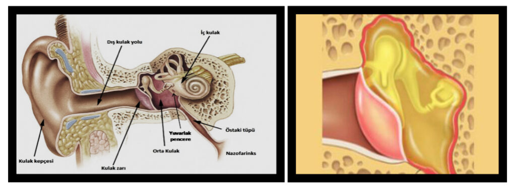 Orta Kulakta Sıvı Birikimi, Çocukluk çağının en sık görülen hastalıklarından olup halk arasında “orta kulakta su toplanması” şeklinde de isim.